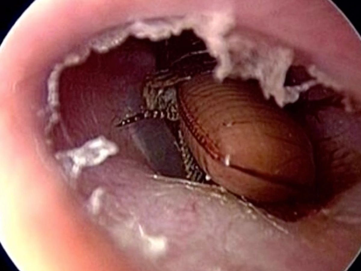 Shocking: A family of cockroach found inside a man's ear: Learn More